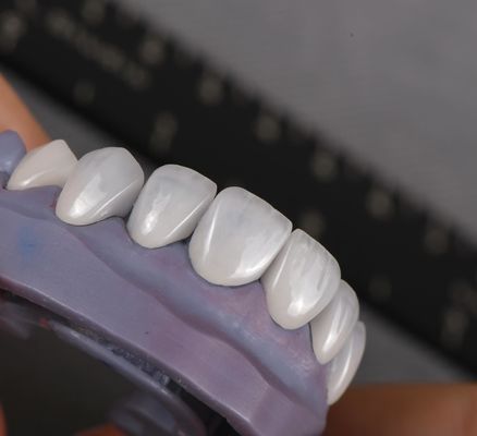Natuurlijke Emax Veneers Kroon Biocompatibiliteit Blekende schaduw met minimale voorbereiding