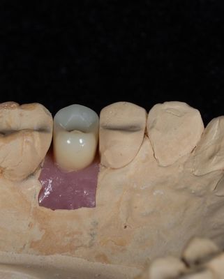 Schroefcement vastgehouden implantaat voor langdurige tandheelkundige implantaten met 5 jaar garantie