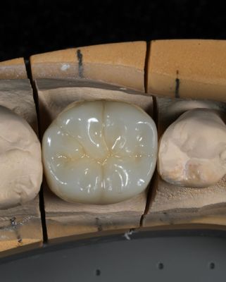 Volledige contour Zirconia kroon snelle omkering voor precieze en esthetische pasvorm in 1 week