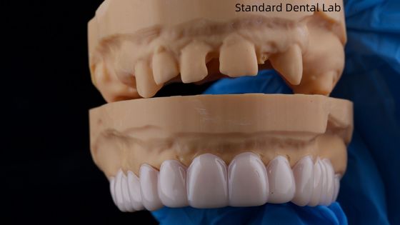 Hoge esthetiek tandheelkundige snap op glimlach standaard tandheelkundig laboratorium verwijderbaar tandheelkundig apparaat