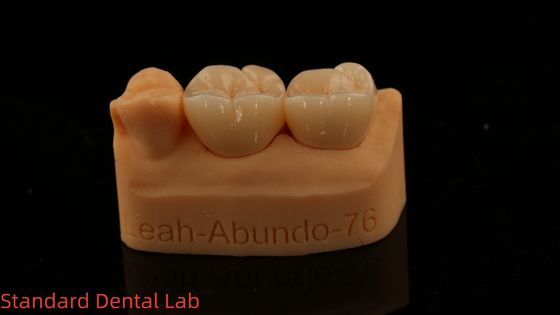 Solid Dental Lab Kronen 3D Pro High Translucency Full Zirconia Kronen met 5 jaar garantie