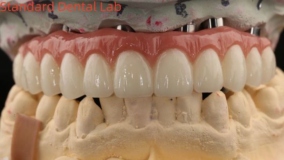 Porselein All On Four Zirconia brug hoge esthetiek tandheelkundige implantaten brug schroef behouden