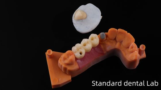 Post Core Dental Lab uit China / Metalen Post Core met PFM Crown