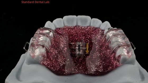 Tandvergroting en distillatie Aanpassing van de expander in de mond Orthodontist Palate expander