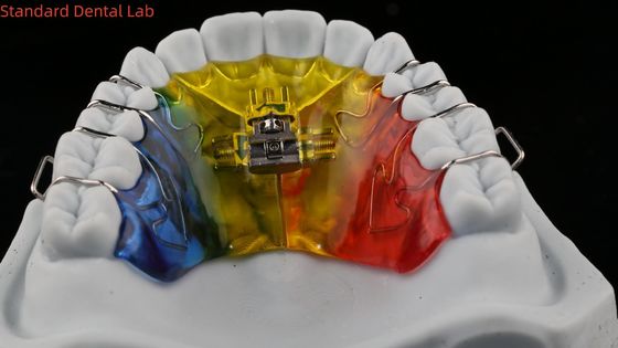 Tandvergroting en distillatie Orthodontist Palate Expander China Tandheelkundig Lab