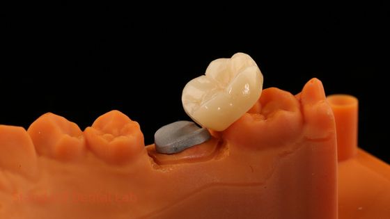 Hoge esthetiek, volledige contour Zirconia kroon met metalen post kern 5 jaar garantie en betere technici van SDL tandheelkundige lab.