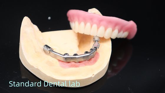 Titanium implantaten ondersteunde prothesen Precise Ivoclar Prothese Over Implantaten