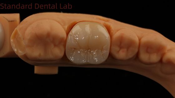 Tandheelkundige digitale volledige circonia kroon met Noritake porselein 3D print model 5 jaar garantie