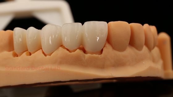 Hoge esthetische voortanden volcontour Zirconia kroon met aangepaste Vita Shade tandheelkundige lab