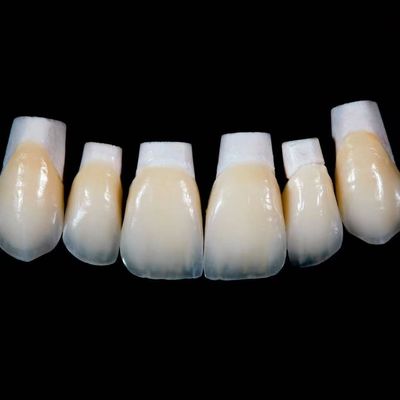Hoogtranslucent Emax porselein veneers kroon met betere materialen door Ivoclar Vivadent
