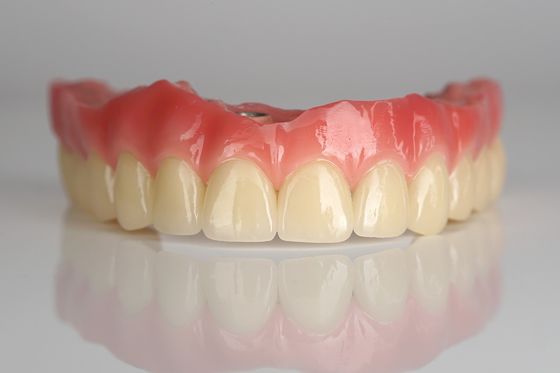 Full Arch Zirconia Implant Bridge All-on-Four / All-on-Six Tandheelkundige Implantaten Snel herstel