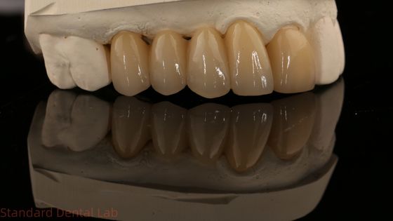 Noritake Porselein Full Contour Zirconia Kroon Hoog Esthetisch Natuurlijke Op maat gemaakte Zirconia Tandbrug