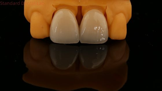 5 jaar garantie Volledige contour Zirconia kroon Op maat gemaakt Vita schaduw Hoge esthetische natuurlijke tandheelkundige brug