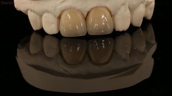 Volledige contour Zirconia kroon en hoge esthetiek natuurlijke gebit brug 5 jaar garantie