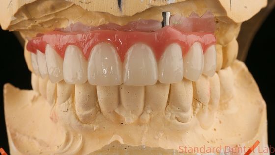 Goed passend Precieze Esthetische Zirconia Porselein Kroon Roze Porselein Met Bleek Schaduw