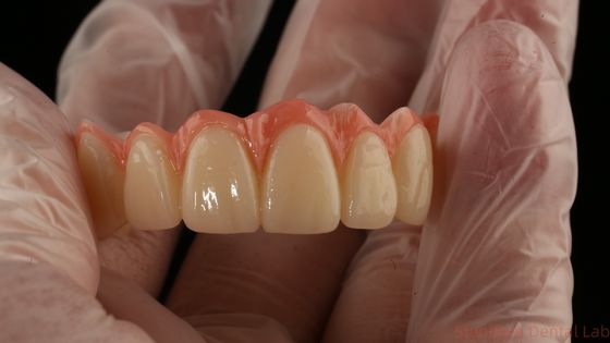 Porselein All On Four Zirconia brug hoge esthetiek tandheelkundige implantaat brug